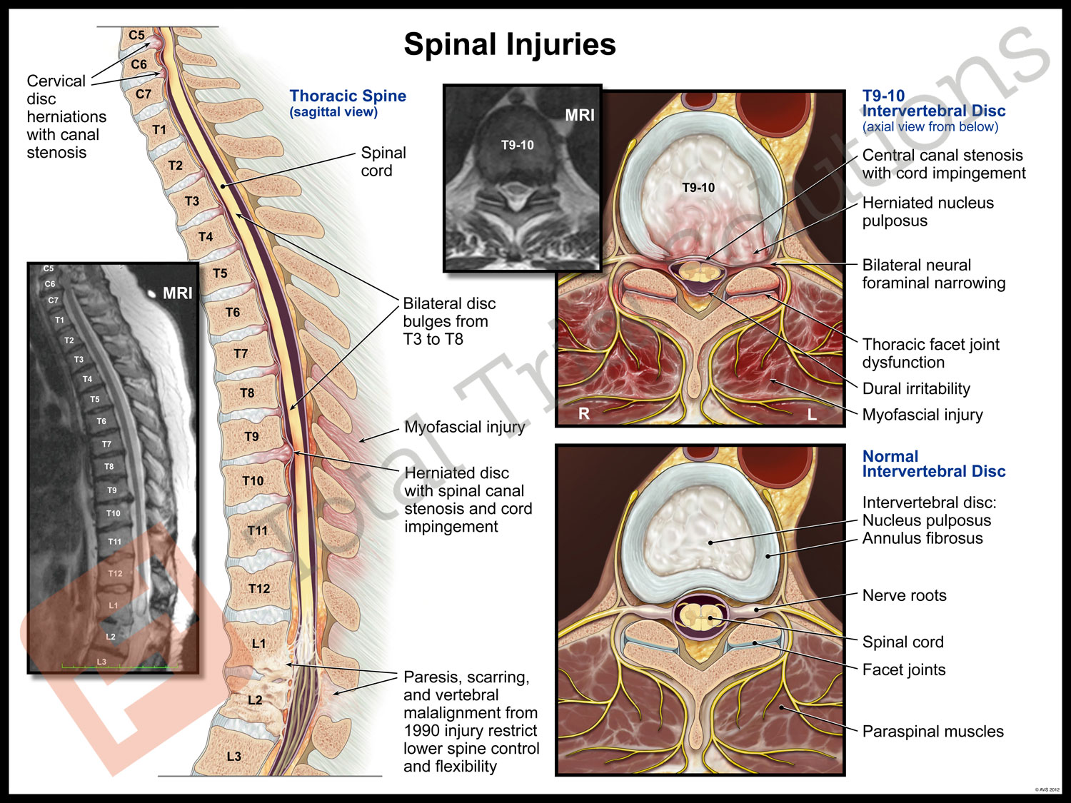 Medical Illustration DIsc Bulges