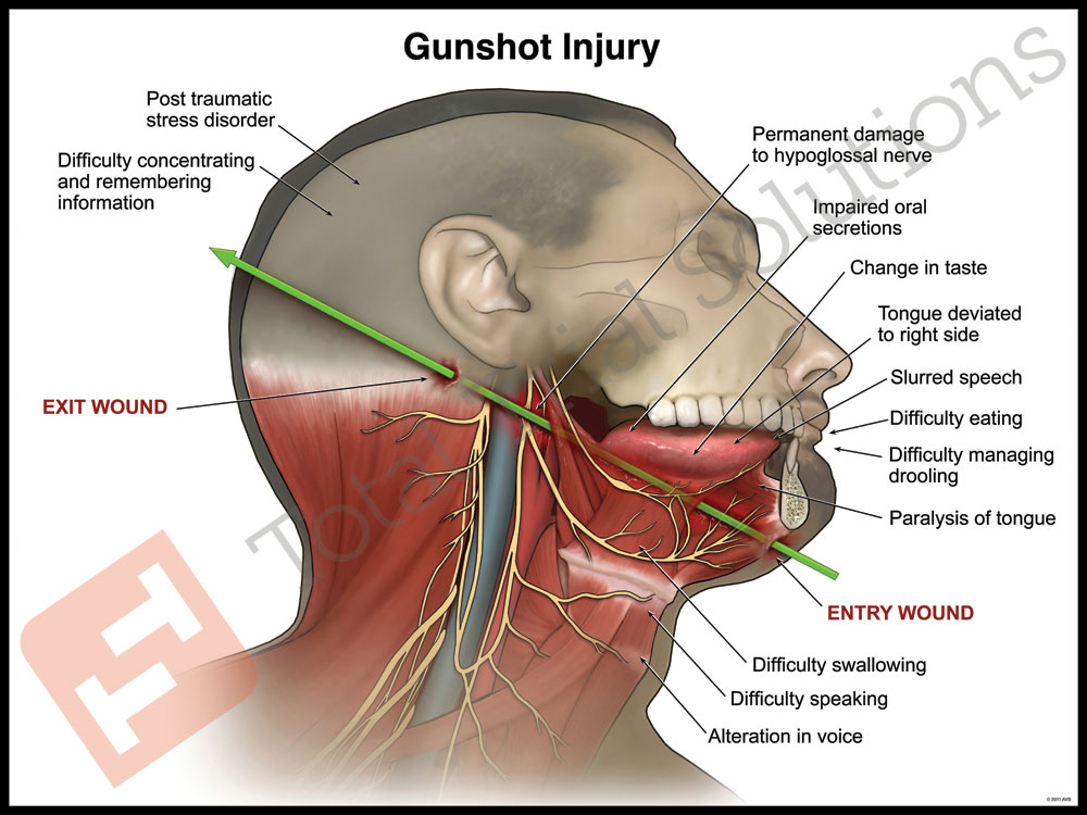 Total Trial Solutions - Gunshot Injury Wound